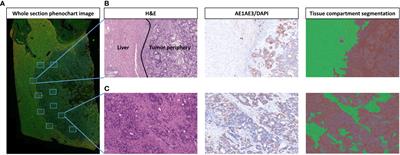 Exploratory study of macrophage polarization and spatial distribution in colorectal cancer liver metastasis: a pilot study